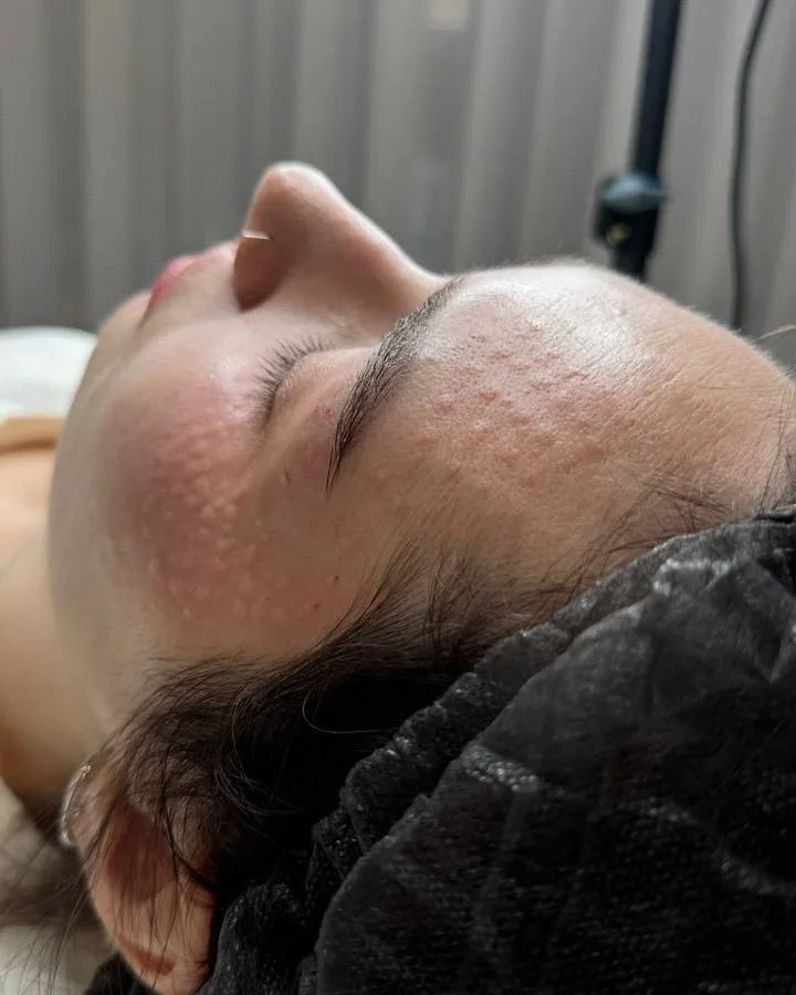 Шкіра одразу після процедури біоревіталізації