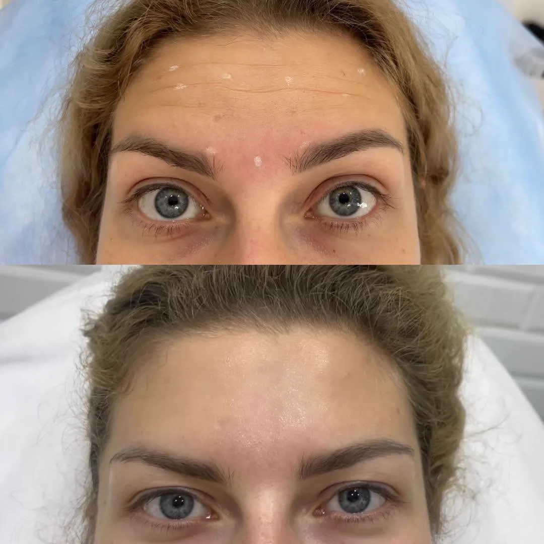 Фото до та після ботулінотерапії: верхня третина обличчя