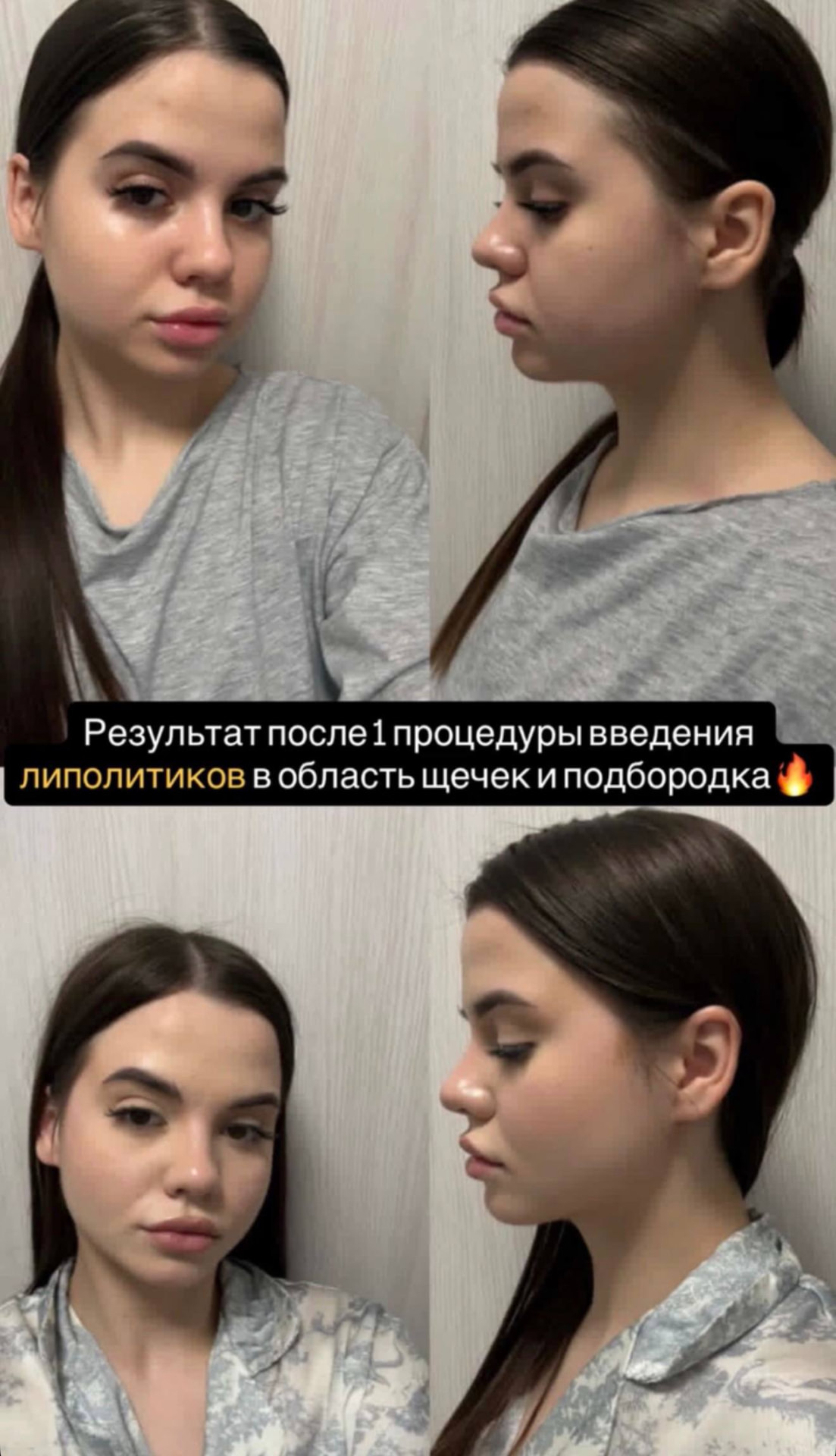 Результат роботи з ділянкою щік і підборіддя